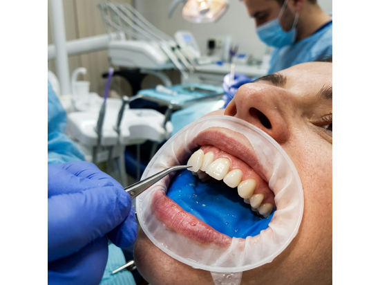 Faccette dentali in ceramica a Lecce - Studio Odon...