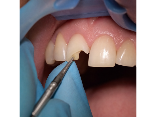 Dente anteriore scheggiato – Studio Odontoiatric...