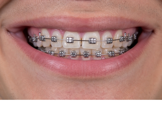 Studio Stere – Apparecchio ortodontico fisso in ...